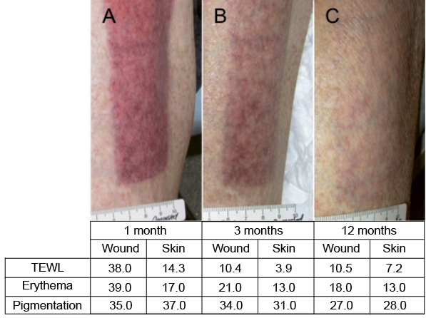 Erythema Persists Longer Than One Year In Split thickness Skin Graft 