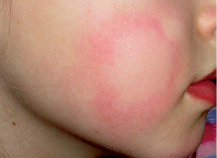 cold urticaria on face