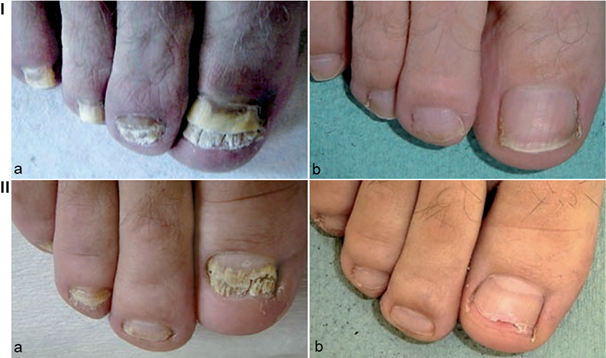 Efficacy Of Fluconazole At A 400 Mg Weekly Dose For The Treatment Of 