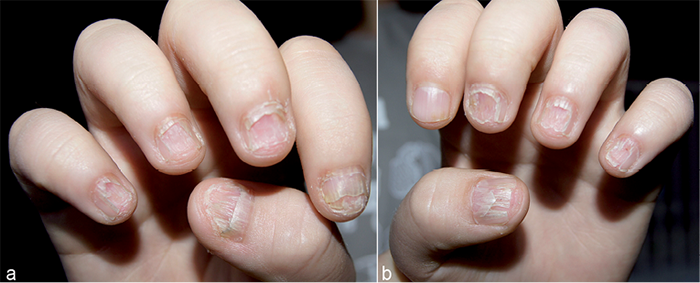 File:Lichen planus in finger nails.JPG - Wikimedia Commons