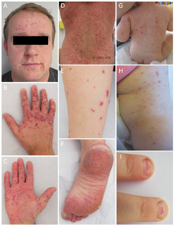 Adult Hand, Foot and Mouth Disease - ROC Private Clinic