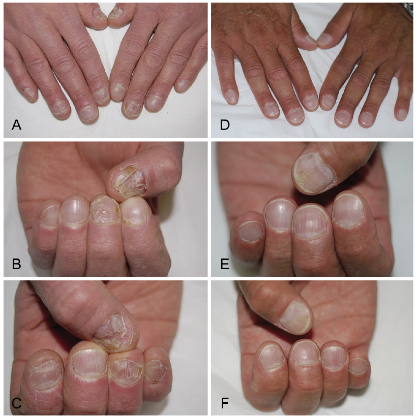 psoriasis on fingernails