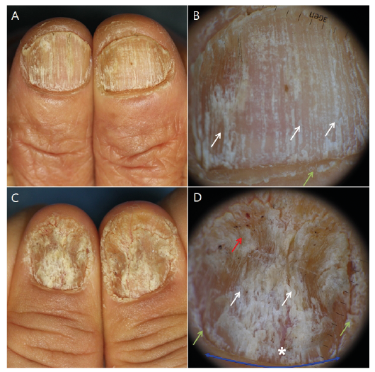 PDF) Dermatoscopy of nail lichen planus | andreia leverone - Academia.edu