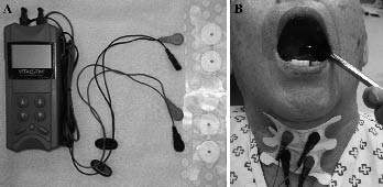 A Clinical Approach to Neuromuscular Electrical Stimulation for Speech and  Swallow in an Acute Rehabilitation Facility