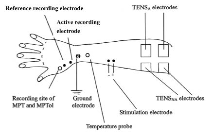 Electrode Placement for Electric Stimulation Charts